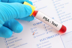 PSA Sreening Test