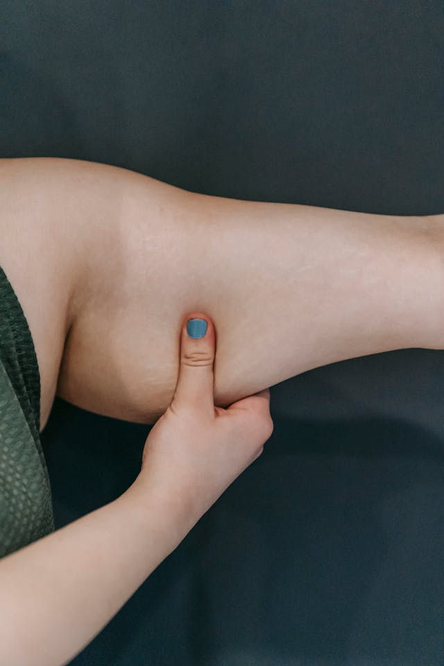 Lipedema