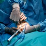 Incision and Drainage