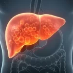 symptoms of fatty liver