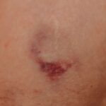 why do i bruise so easily