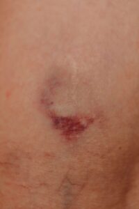 why do i bruise so easily