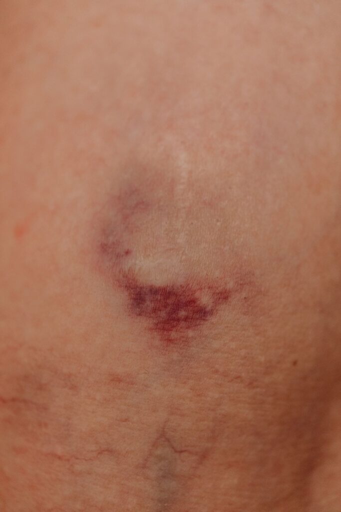 why do i bruise so easily