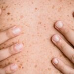Skin lesions