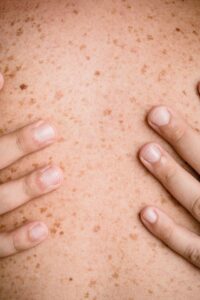 Skin lesions