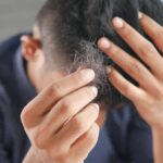Hair loss
