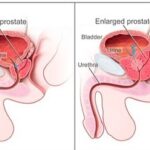 Enlarged prostate