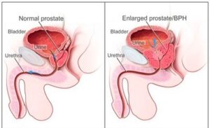 Enlarged prostate