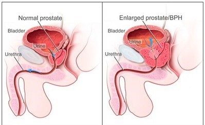 Enlarged prostate