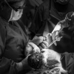 Cesarean section